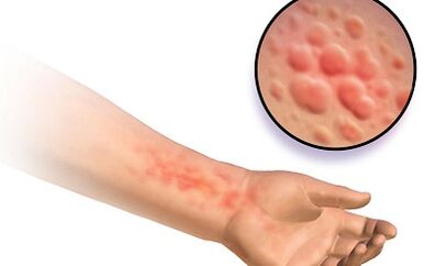 Schistosomosis manifestations in man